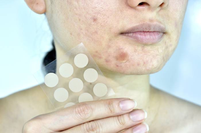 how to make acne patches more effective