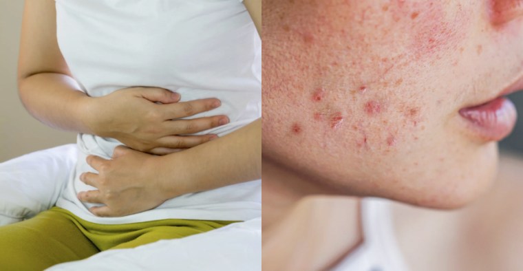 food poisoning acne featured