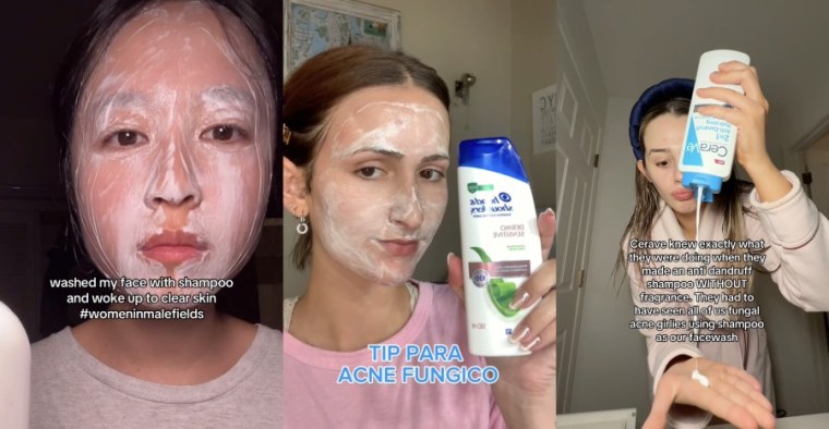 dandruff shampoo for acne